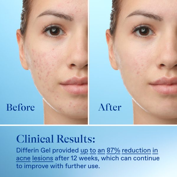 Differin Adapalene Gel 0.1% Acne Treatment with Retinoid, 1.6 oz - Image 2